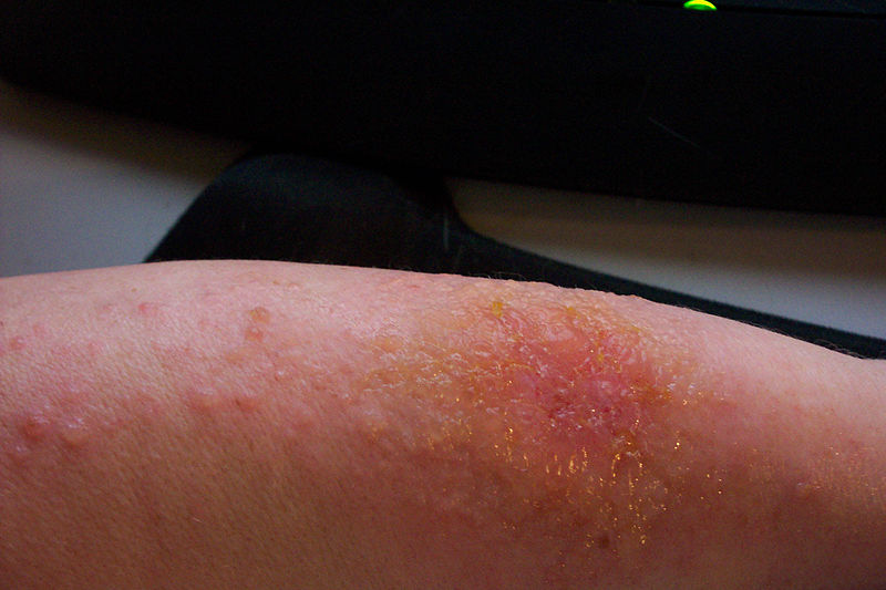    . Urushiol-induced contact dermatitis