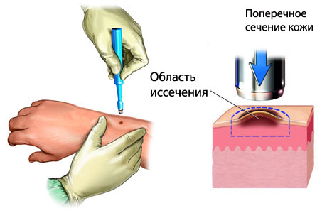 melanoma-2[1].jpg